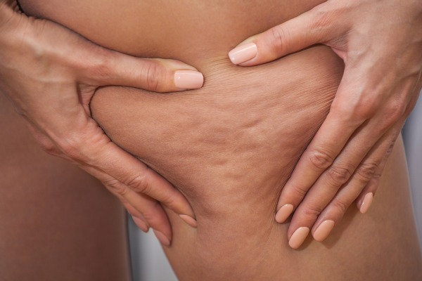 Cellulite, Fat Deposits