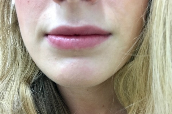 Before Lip Filler