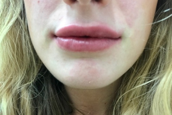 Immediately After Lip Filler