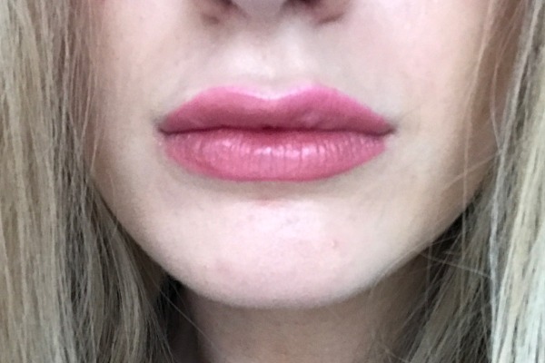 1 Week After Lip Filler