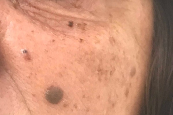 Before Plexr mole removal