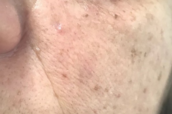 Immediately after Plexr mole removal