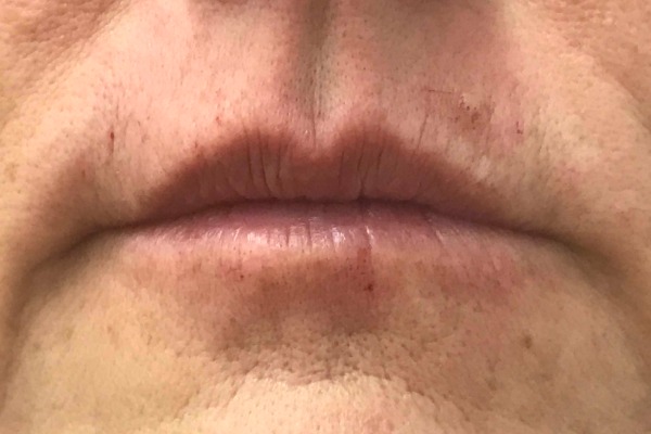 Juvederm immediately after