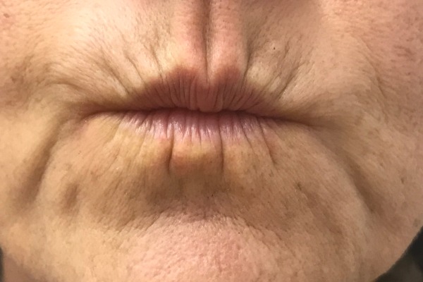 Juvederm Before