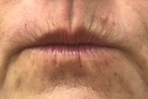 Juvederm immediately after