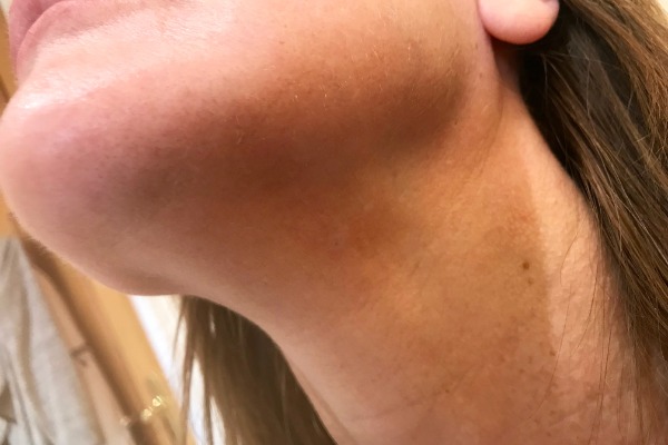 Immediately after mole removal neck