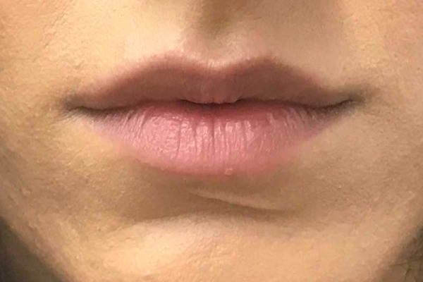 Juvéderm lips before