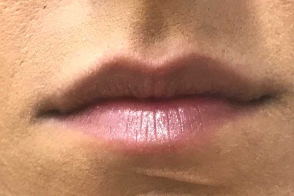 Juvéderm lips after