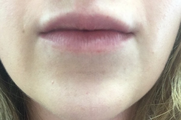 Before Lip Filler