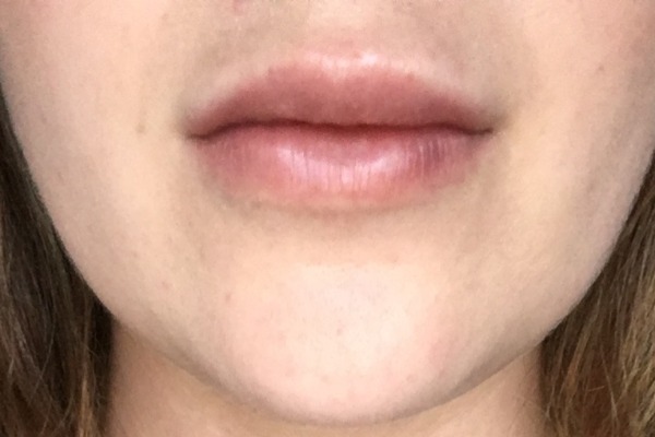 After Lip Filler