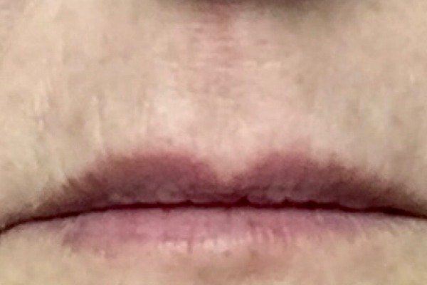 After Lip Line Fillers