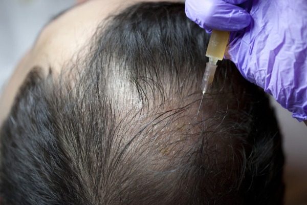 PRP ( Platelet Rich Plasma) For Hair Loss